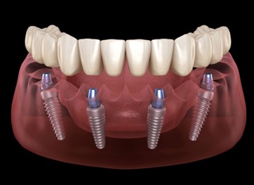 Dental implant 