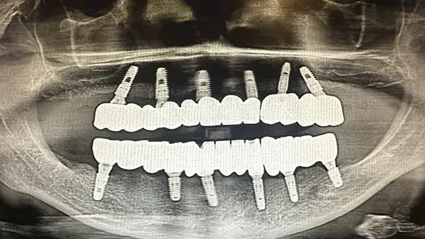 Dental implant