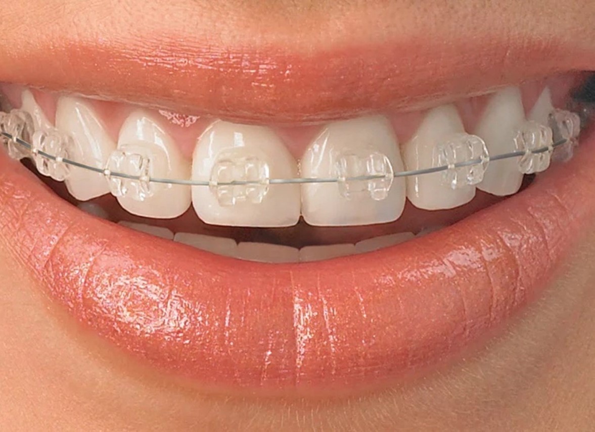 invisalign 