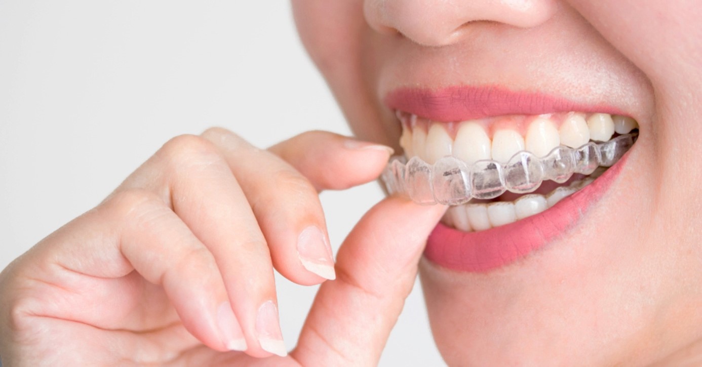 invisalign 