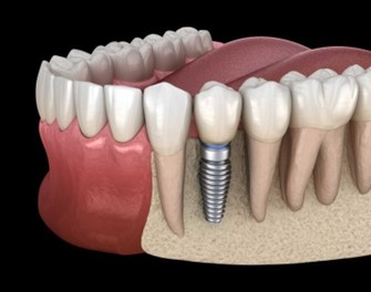 Dental implant 